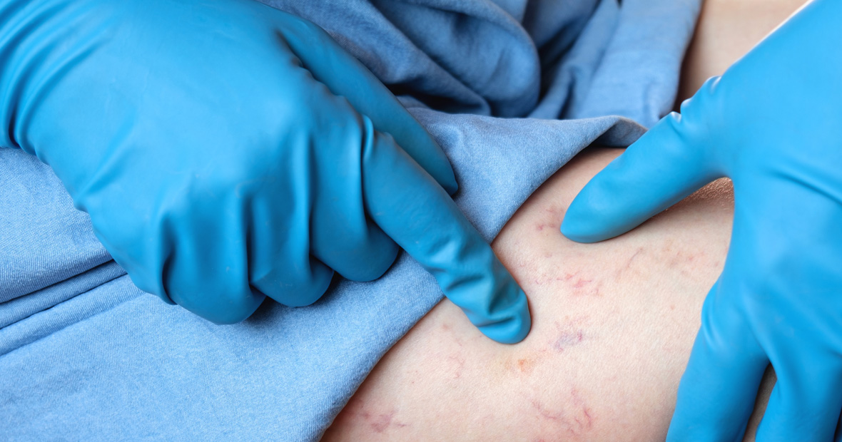 pathologies veineuses